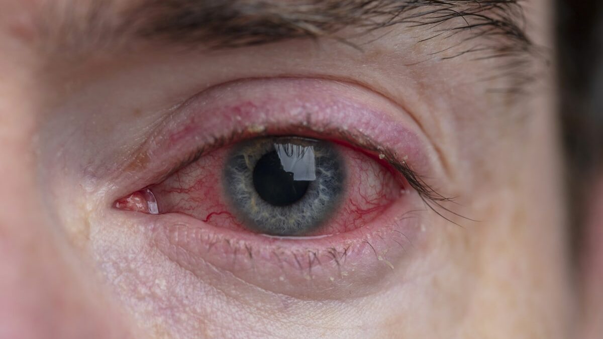 Qu’est-ce qui provoque les yeux rouges ?